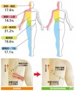 帶狀皰疹癥狀表現(xiàn)是什么樣的？